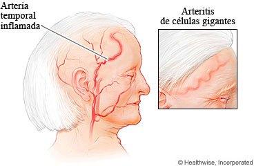 Arteritis de Células Grandes y Polimialgia reumática: posible causa de dolor de cabeza y hombros artricenter