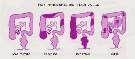 Enfermedad de Crohn