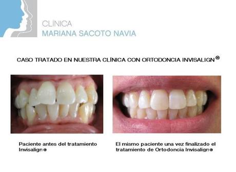 ¿Quieres tener una sonrisa de cine el día de tu boda? ANTES Y DESPUES INV DALIA