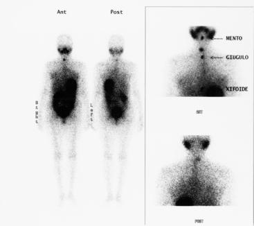 ¿Que detecta una Gammagrafía? Scintigraphy