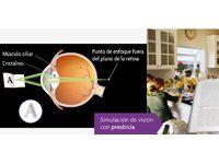 Se publica el Libro Blanco de la Cirugía Multifocal Intraocular