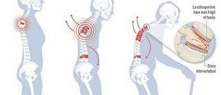 Casi un millón de hombres sufren en España de osteoporosis