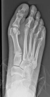 CASO CLINICO HALLUX VALGUS Y METATARSALGIA CASO CLINICO HALLUX VALGUS Y METATARSALGIA