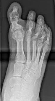 CASO CLINICO HALLUX VARUS