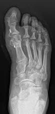 CASO CLINICO HALLUX VARUS