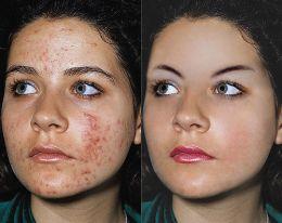 Como Reducir el Acne Hormonal Como Reducir el Acne Hormonal