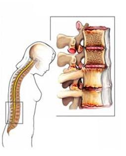 Deficiencia, discapacidad y minusvalía: un acercamiento a los conceptos espondiloartrosis lumbar