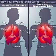 Situs Inversus o cuando el cuerpo está todo al revés