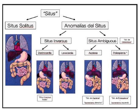 Situs Inversus o cuando el cuerpo está todo al revés