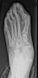 PIE PLANO DEL ADULTO ASOCIADO A HALLUX VALGUS