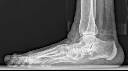 PIE PLANO DEL ADULTO ASOCIADO A HALLUX VALGUS