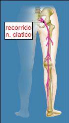 Ciática en el embarazo tratamiento+de+la+ciatica
