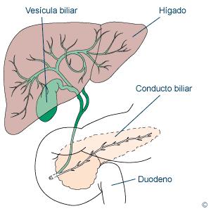 Tratamiento Calculos Biliares Tratamiento Calculos Biliares