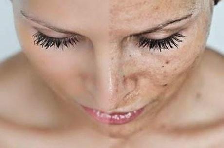 Lo último en tratamientos para combatir las manchas Lo último en tratamientos para combatir las manchas