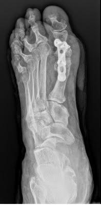 RECONSTRUCCIÓN DE CIRUGÍA FALLIDA DE HALLUX VALGUS.