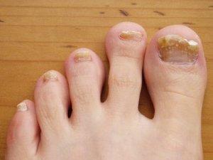 8 Maneras de Como Curar el Hongo en los Pies y las Uñas