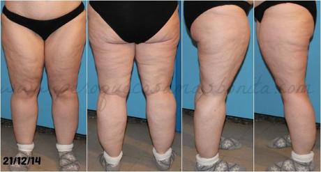 Reporte tras 3 semanas usando Silk'n Silhouette Reporte tras 3 semanas usando Silk'n Silhouette