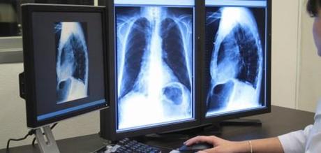 detección de cáncer de pulmón