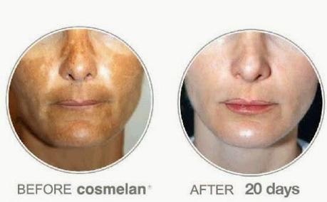 Eliminando manchas de pigmentación con Cosmelan
