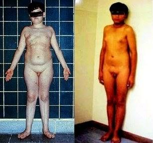 Síndrome de Klinefelter: ¿Una X de mas? Síndrome de Klinefelter: ¿Una X de mas?