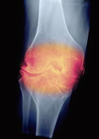 Relación entre la osteoartritis de rodilla y el peso al nacer