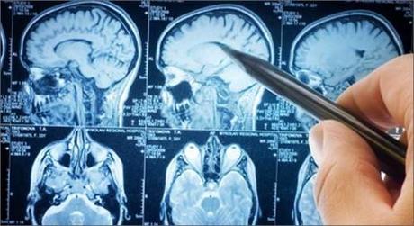 Dieta cetogénica como tratamiento de la epilepsia Dieta cetogénica como Tratamiento de la epilepsia