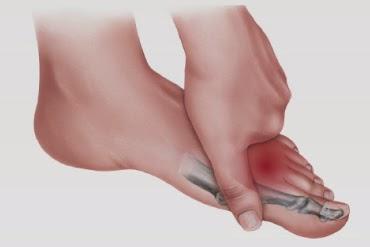 ¿Conoces el Neuroma interdigital plantar?