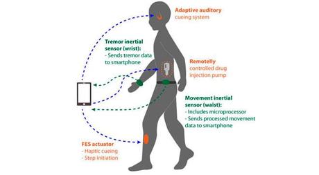 Cinturón con sensores y estimuladores para tratar el Parkinson