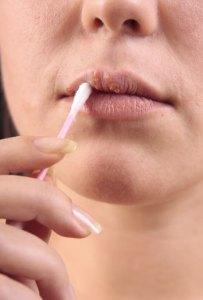 Remedio natural para las calenturas del herpes labial remedios-caseros-herpes