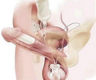 Llega la prótesis de pene Llega la prótesis de pene