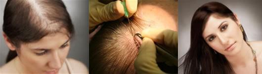 Injerto de cabello fotos Tipos de injerto de cabello