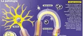 Esclerosis múltiple: los primeros tratamientos en forma de pastillas invitan al optimismo Esclerosis múltiple: los primeros tratamientos en forma de pastillas invitan al optimismo