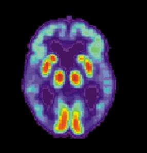 PET-scan-of-Alzheimers-disease-brain2 Mecanismo infeccioso detectado en el Alzheimer
