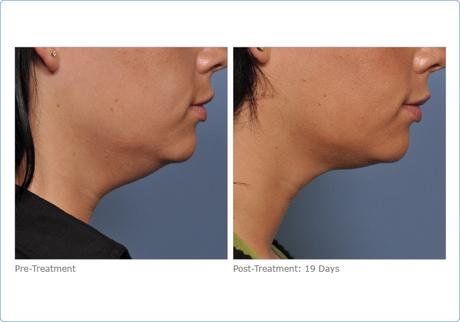 Adiós al bisturí, hola a las técnicas no invasivas Adiós al bisturí, hola a las técnicas no invasivas