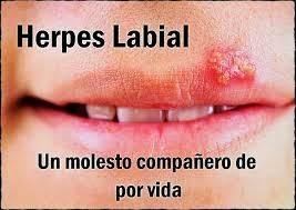 ¿HERPES BUCAL? ¡HAZ QUE DESAPAREZCA! ¿HERPES BUCAL? ¡HAZ QUE DESAPAREZCA!