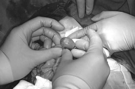 Extracción de un fitobezoar de oliva del duodeno de una paciente de 11 años phytobezoar fitobezoar olive oliva