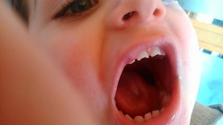 ¿Se ha hecho tu peque un chichón hoy? Como actuar cuando se dan un golpe. ¿Se ha hecho tu peque un chichón hoy? Como actuar cuando se dan un golpe.