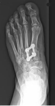 NUEVO CASO DE LESION DE LISFRANC