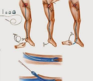 LAS VARICES LAS VARICES