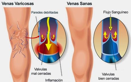 LAS VARICES LAS VARICES