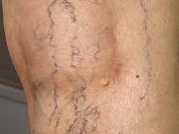 LAS VARICES LAS VARICES