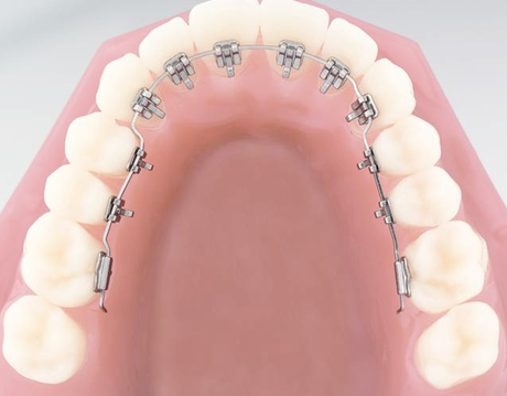 En qué consiste un tratamiento de Ortodoncia ORTODONCIA TRADICIONAL
