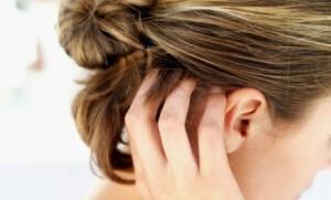 6 Efectivos Tratamientos Naturales para la Caspa 6 Efectivos Tratamientos Naturales para la Caspa