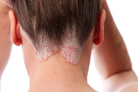 ¿ Psoriasis o Eczema? Psoriasis o Eczema