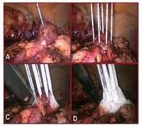 Tratamiento de las Arritmias Cardiacas con Crioablacion