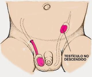 La criptorquidia La criptorquidia