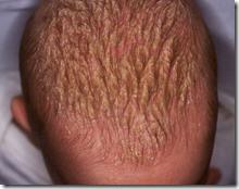 Fontanelas y costra láctea Fontanelas y costra láctea