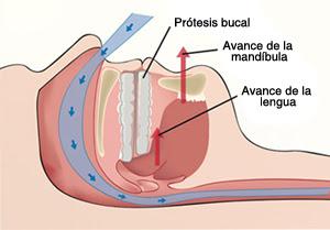 TRATAMIENTOS DEL RONQUIDO Y LA APNEA DEL SUEÑO