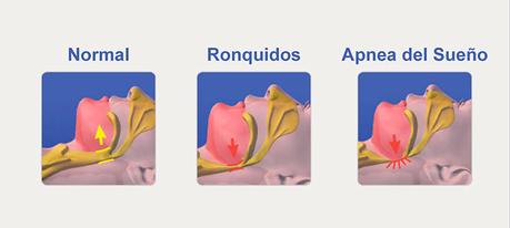 Universidad de Washington desarrolla una app capaz de detectar Apnea del sueño Universidad de Washington desarrolla una app capaz de detectar Apnea del sueño