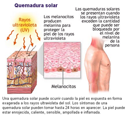 Que hacer ante una quemadura solar